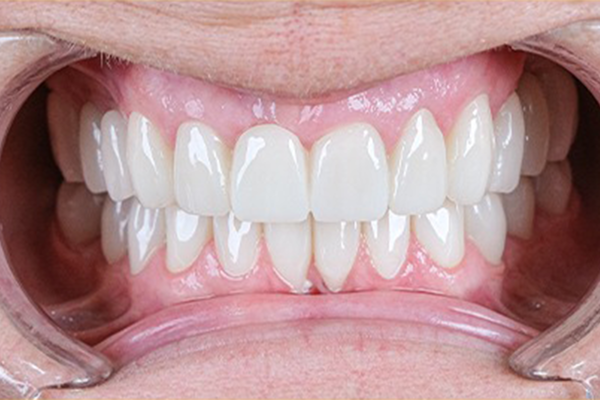 Zirconium crown dental treatment before and after comparison at Luxury Dental - after treatment