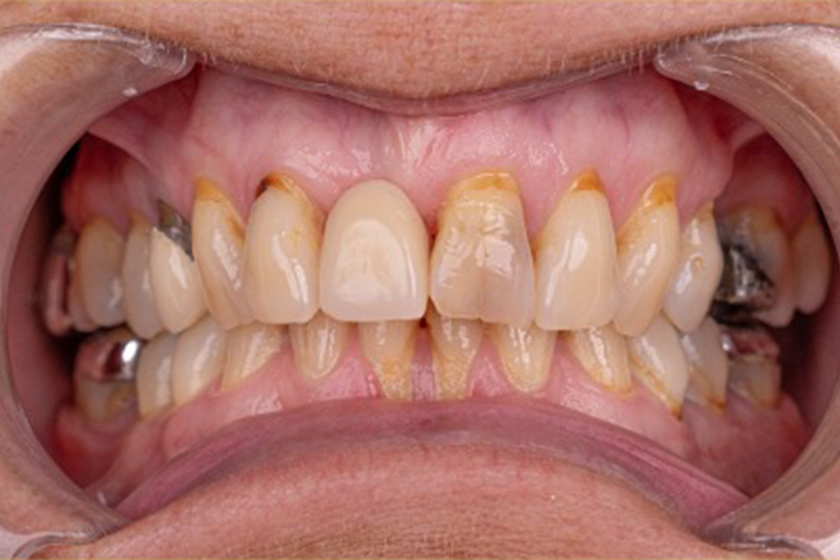 Zirconium crown dental treatment before and after comparison at Luxury Dental - before treatment