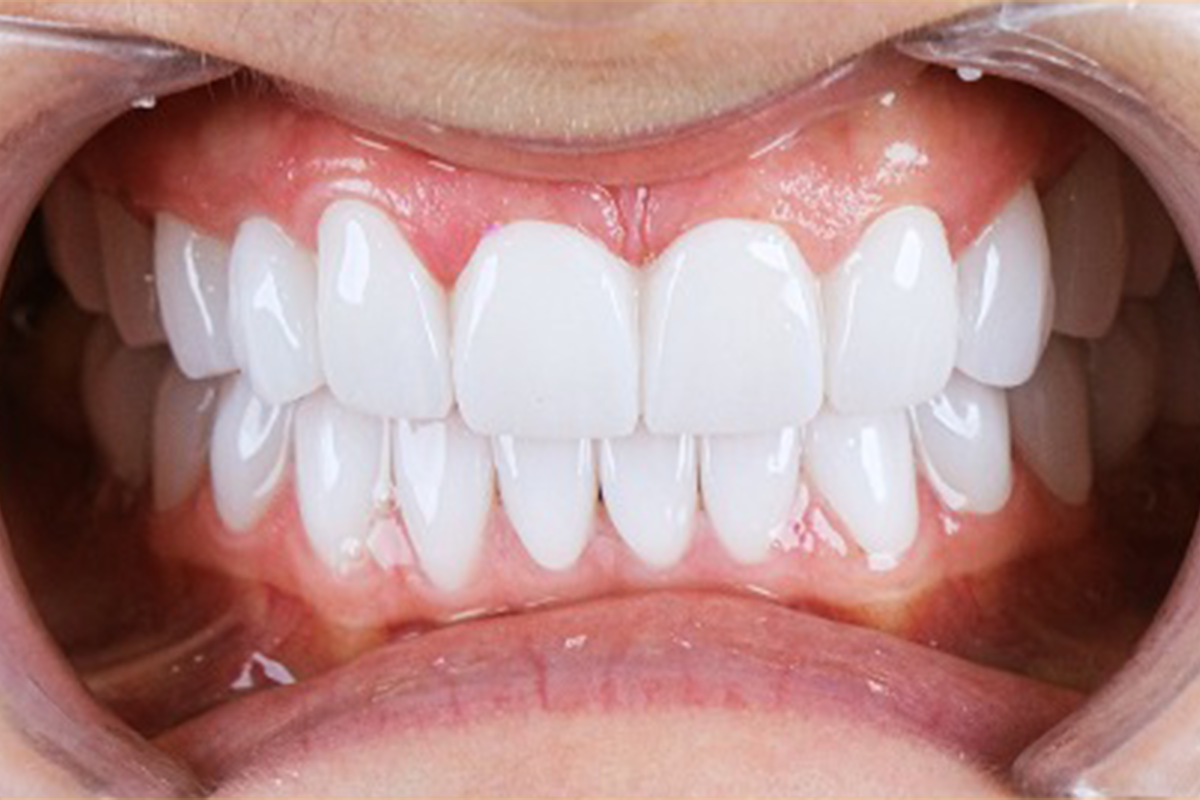 Zirconium crown smile transformation before and after result - after treatment