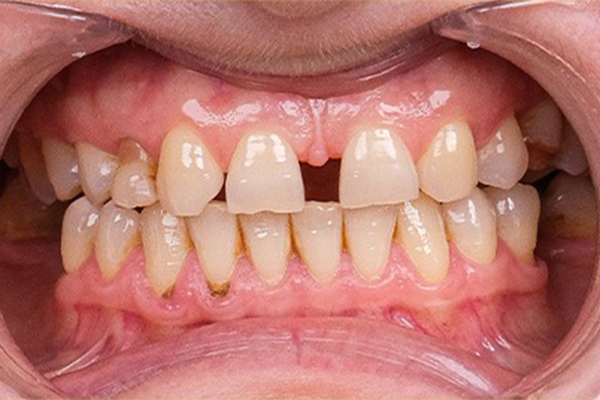Zirconium crown smile transformation before and after result - before treatment