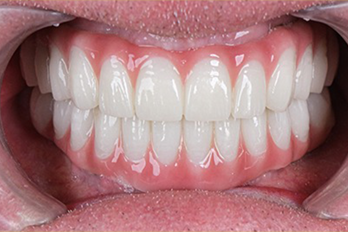 All-on-6 full-arch dental implant before and after results - after treatment