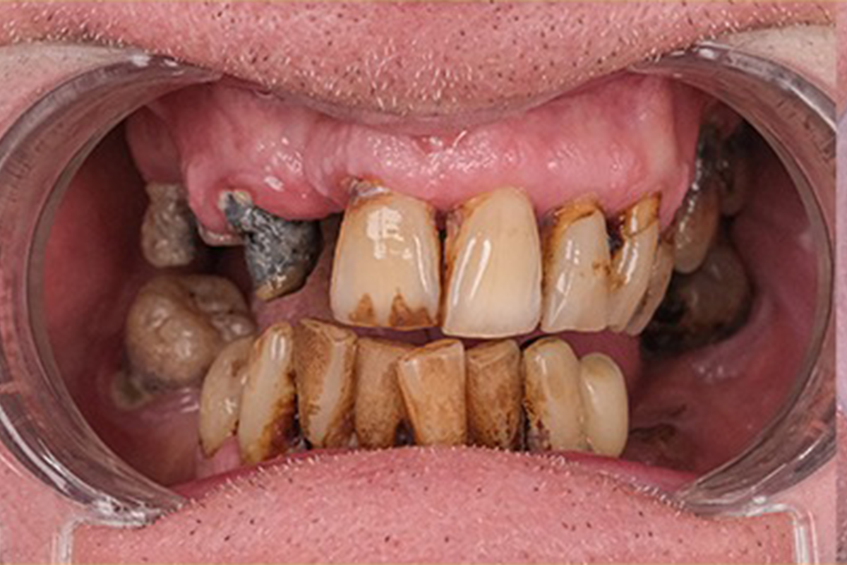 All-on-6 full-arch dental implant before and after results - before treatment