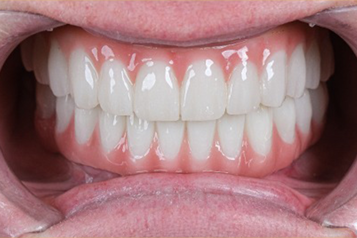 All-on-4 dental implant full mouth restoration before and after - after treatment