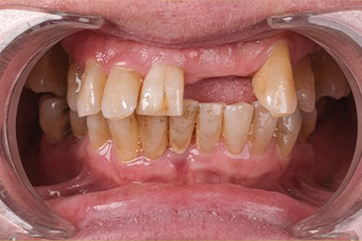All-on-4 dental implant full mouth restoration before and after - before treatment