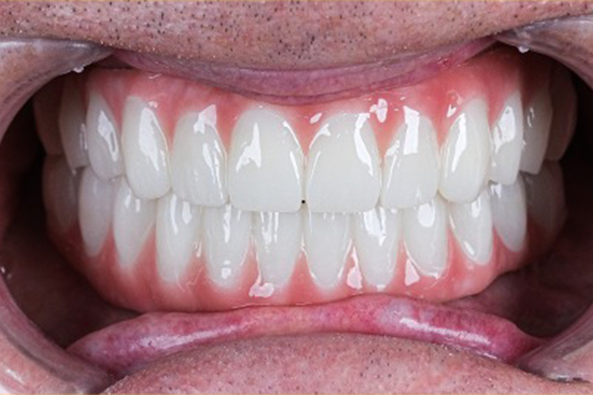 All-on-6 full-arch smile reconstruction before and after result - after treatment