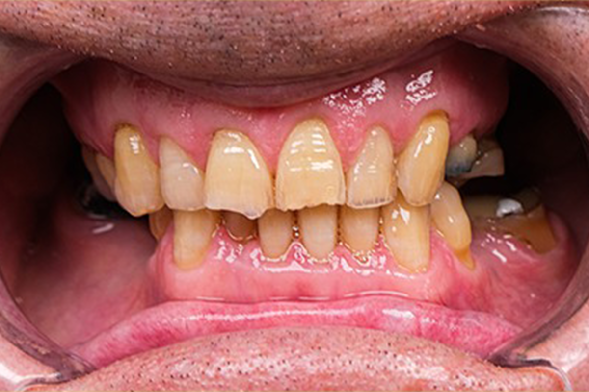 All-on-6 full-arch smile reconstruction before and after result - before treatment