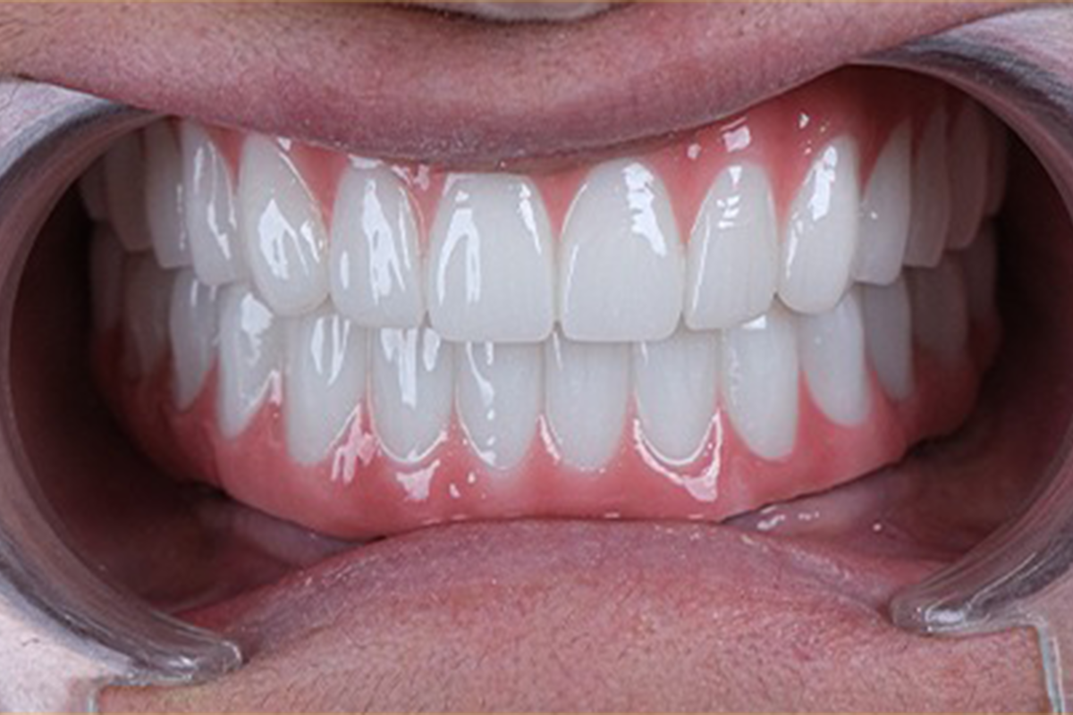All-on-6 implant-supported dental bridge before and after comparison - after treatment