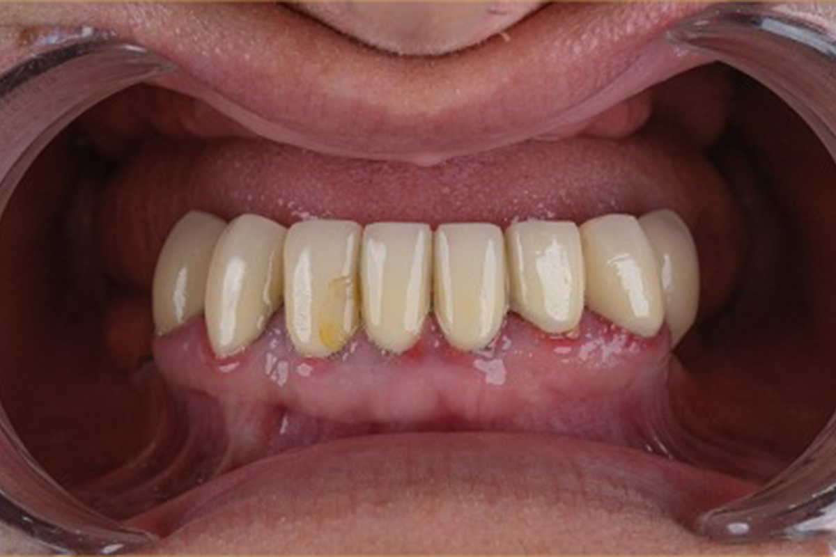 All-on-6 implant-supported dental bridge before and after comparison - before treatment
