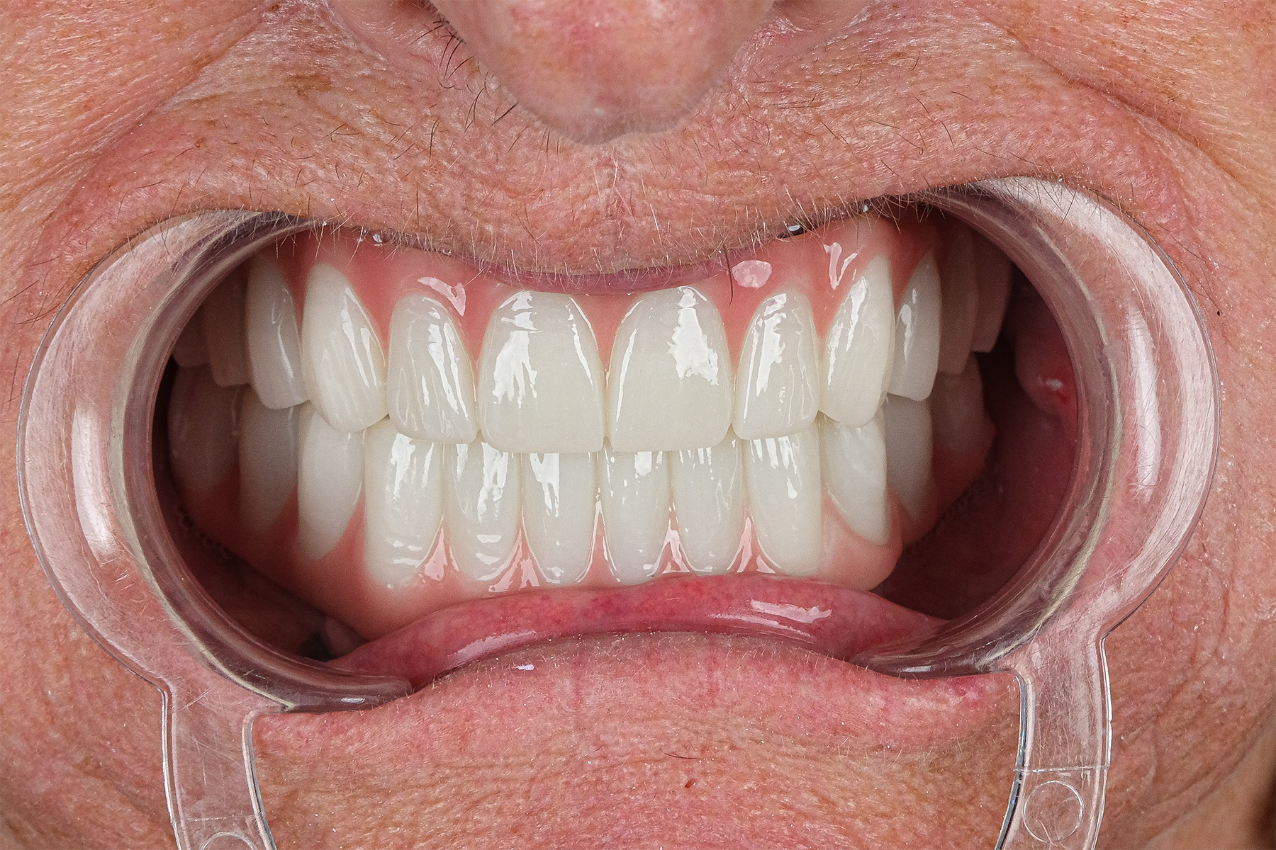 All-on-6 full-arch dental implant before and after at Luxury Dental - after treatment