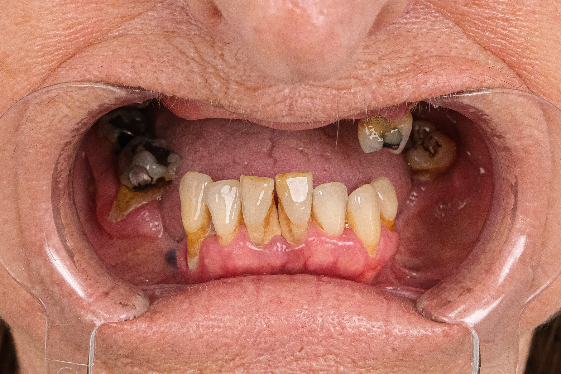 All-on-6 full-arch dental implant before and after at Luxury Dental - before treatment