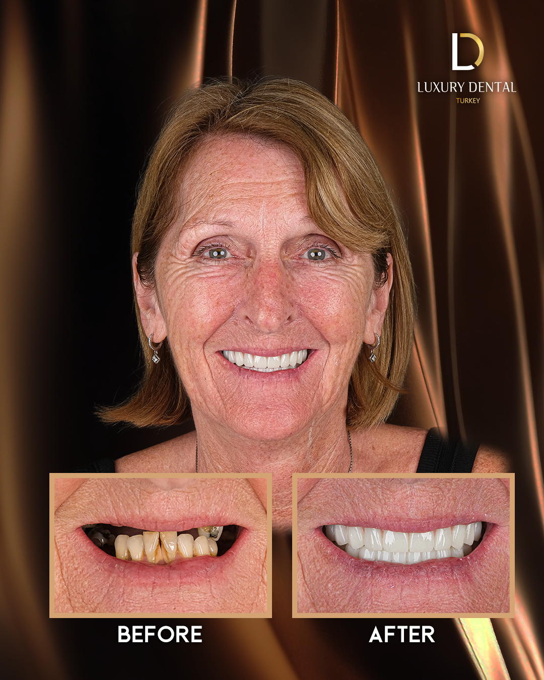 All-on-6 full-arch dental implant before and after at Luxury Dental