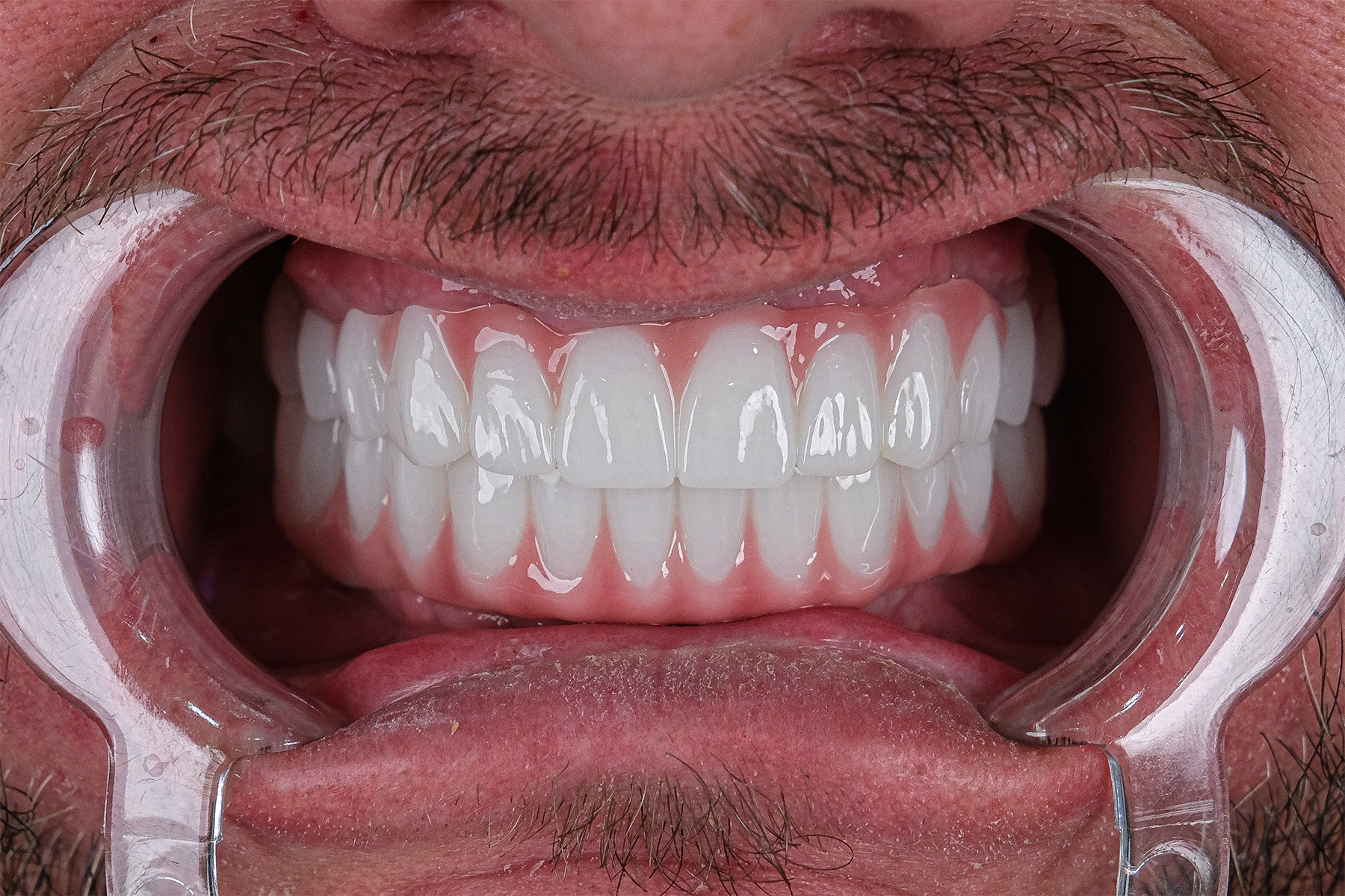 All-on-6 full-arch dental implant before and after at Luxury Dental - after treatment