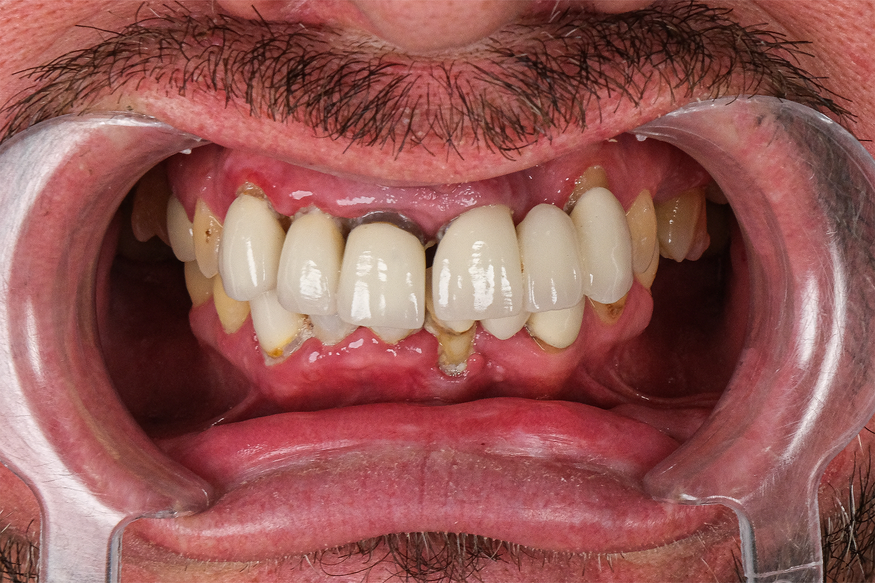 All-on-6 full-arch dental implant before and after at Luxury Dental - before treatment