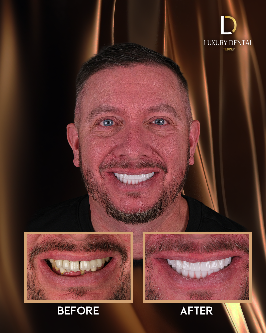 All-on-6 full-arch dental implant before and after at Luxury Dental