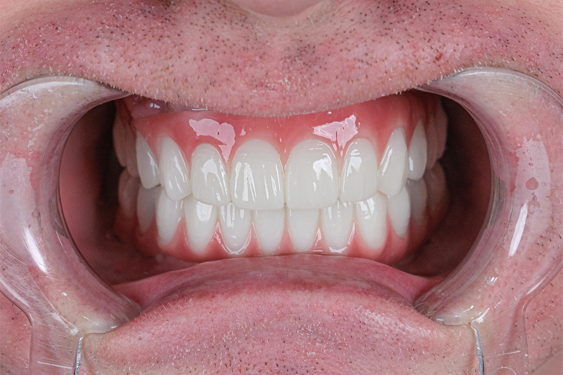 All-on-6 full-arch dental implant before and after at Luxury Dental - after treatment
