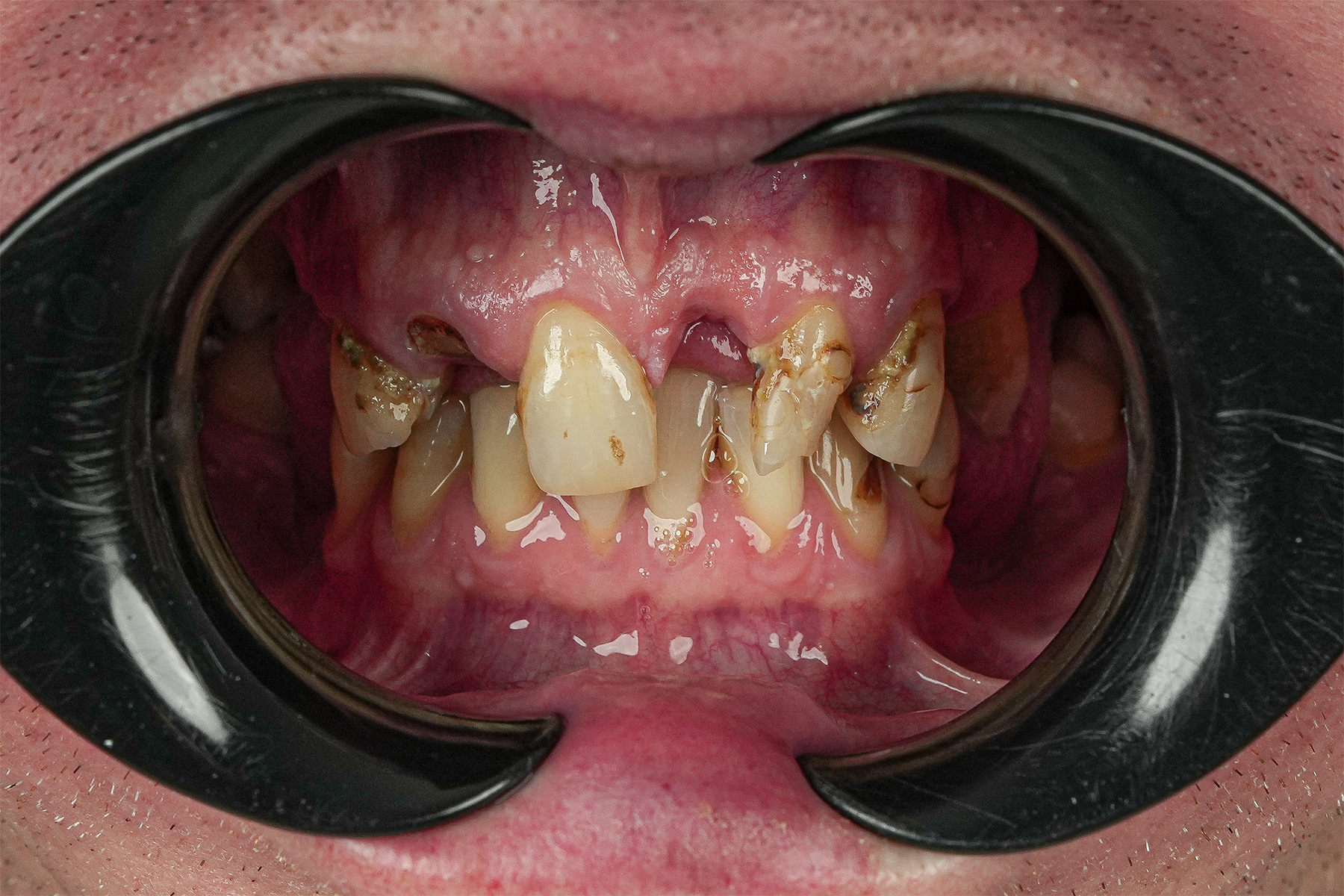 All-on-6 full-arch dental implant before and after at Luxury Dental - before treatment
