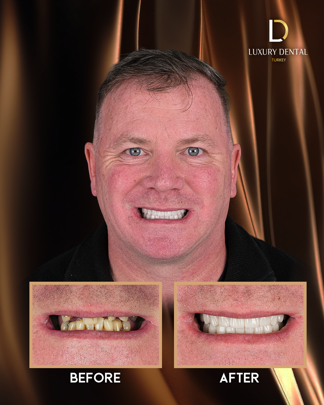 All-on-6 full-arch dental implant before and after at Luxury Dental