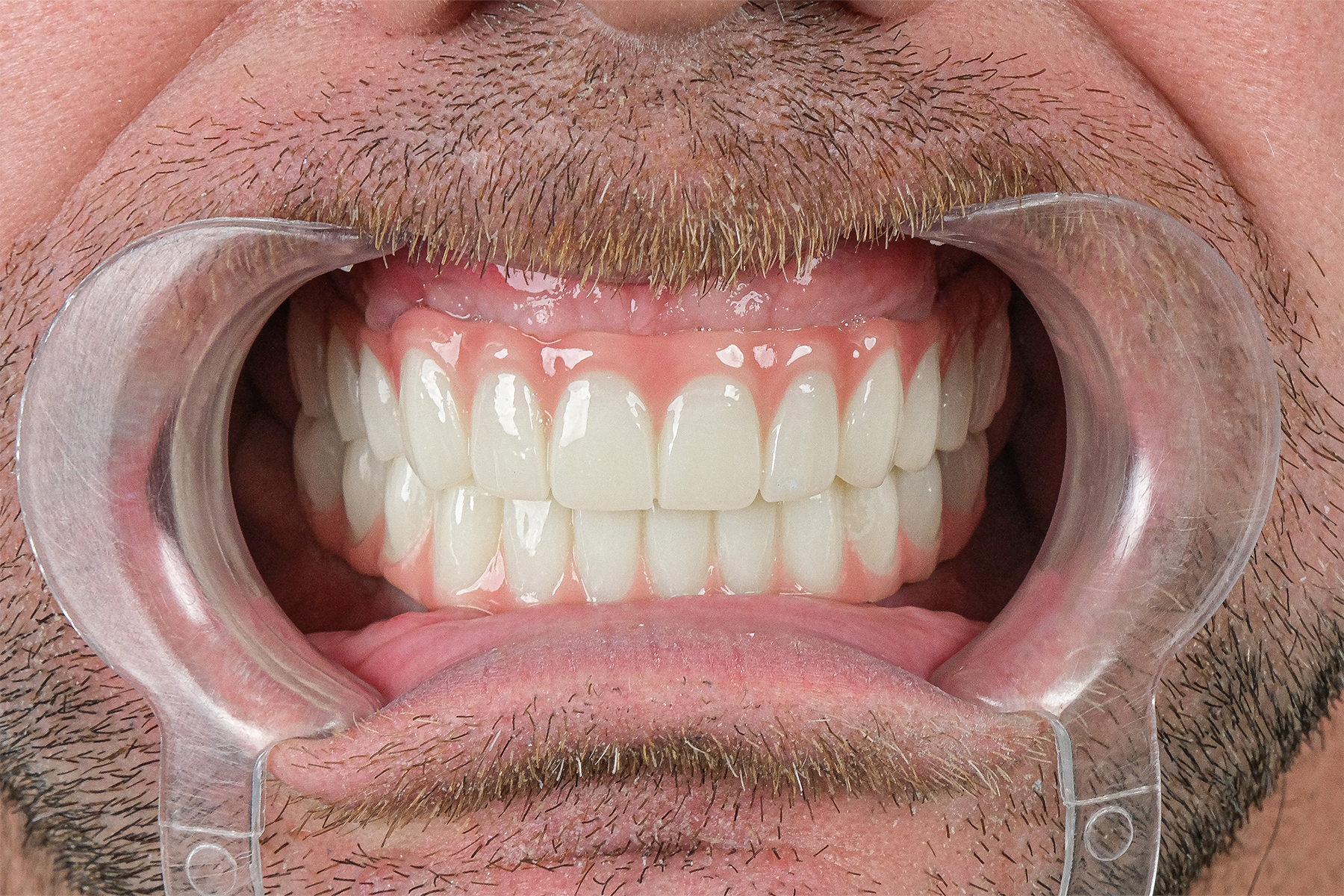Full smile makeover before and after at Luxury Dental - after treatment