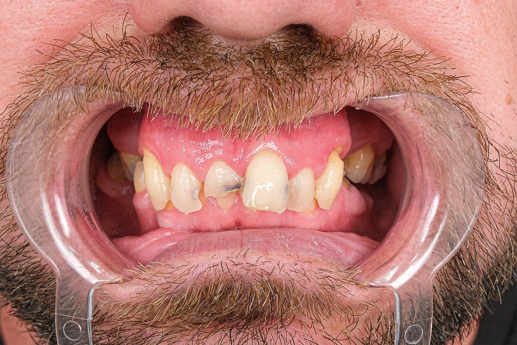 Full smile makeover before and after at Luxury Dental - before treatment