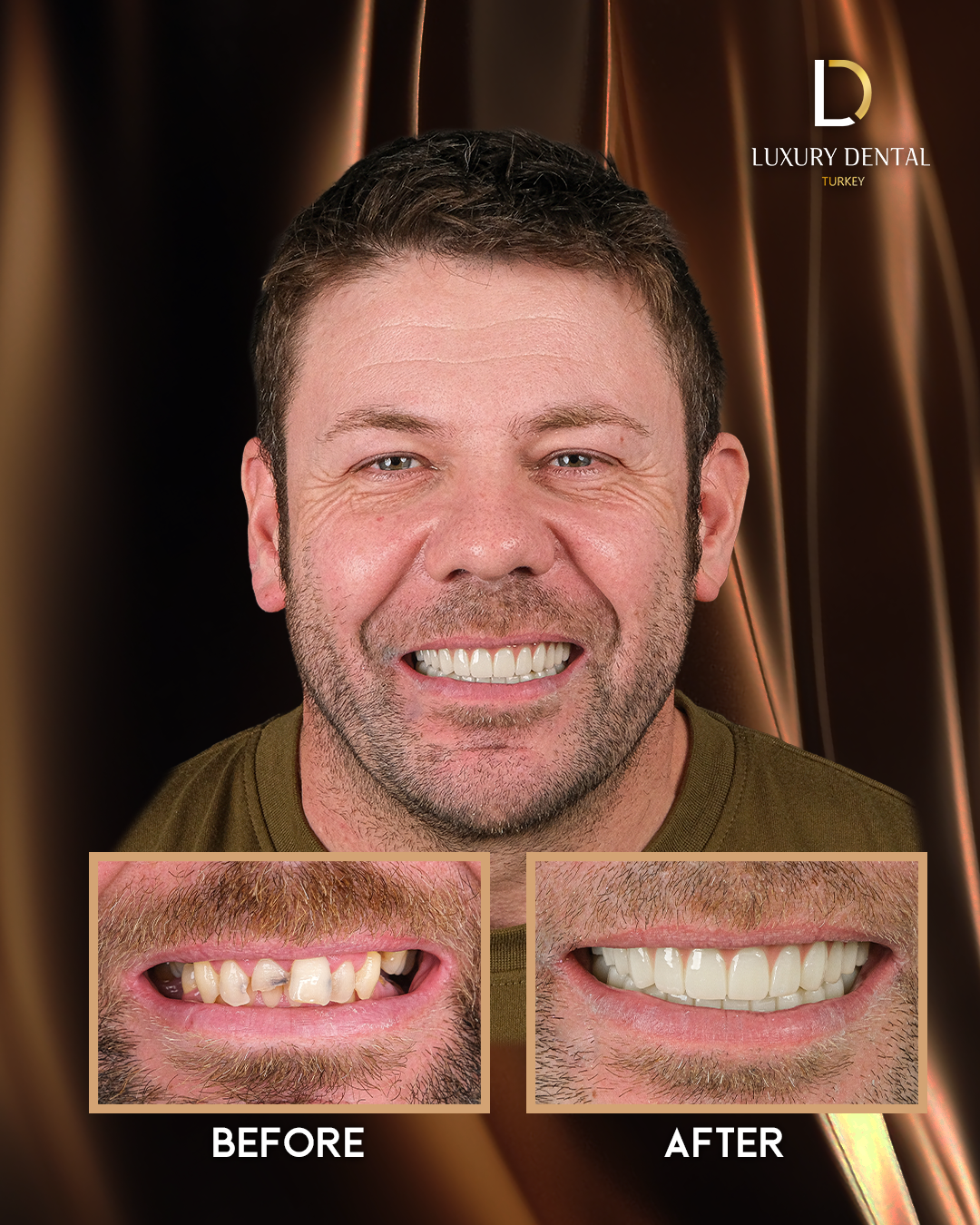 Full smile makeover before and after at Luxury Dental