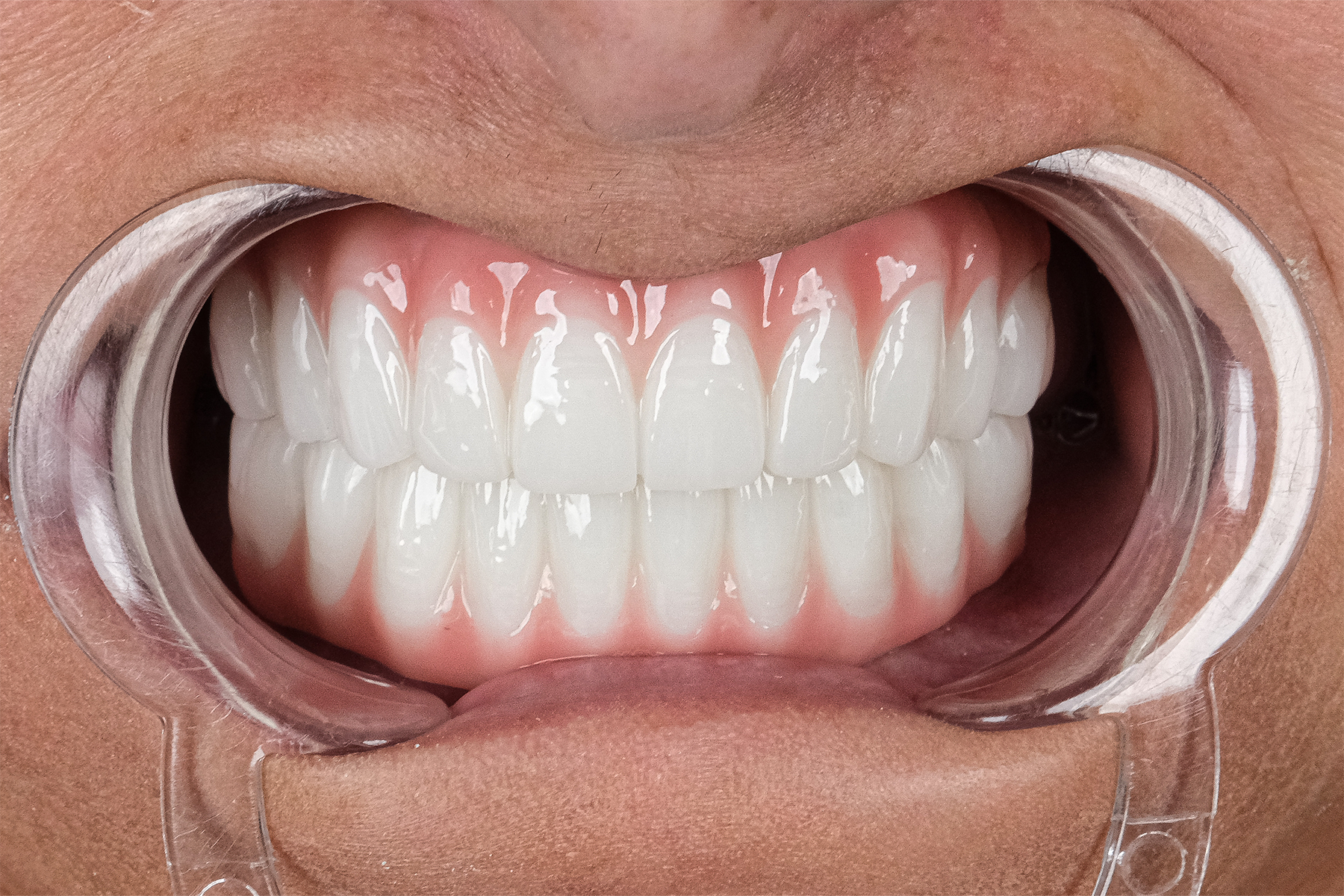 Full smile makeover before and after at Luxury Dental - after treatment