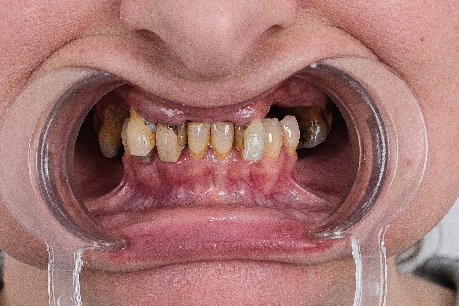 Full smile makeover before and after at Luxury Dental - before treatment