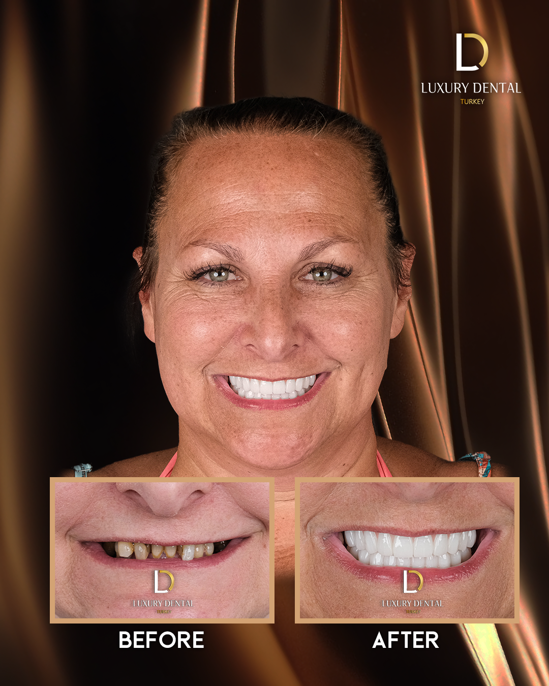 Full smile makeover before and after at Luxury Dental