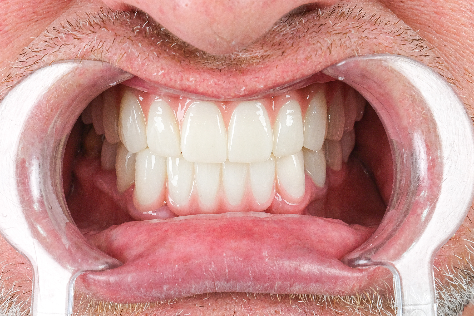 Full smile makeover before and after at Luxury Dental - after treatment