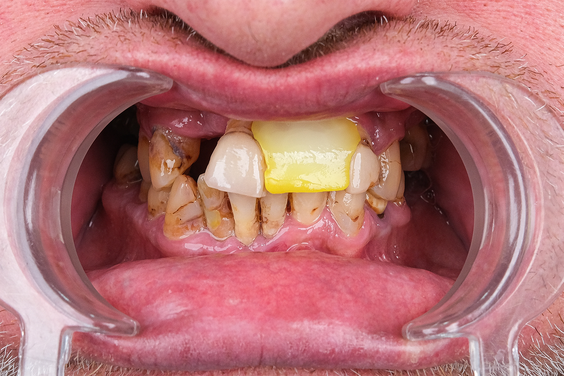 Full smile makeover before and after at Luxury Dental - before treatment