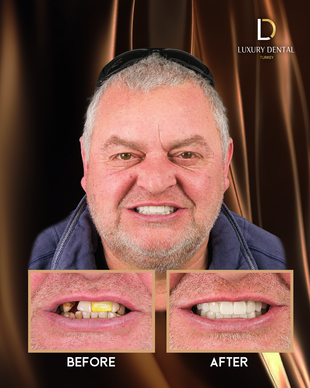 Full smile makeover before and after at Luxury Dental