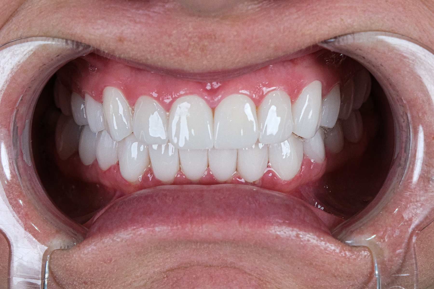 Zirconium crown smile transformation before and after at Luxury Dental - after treatment