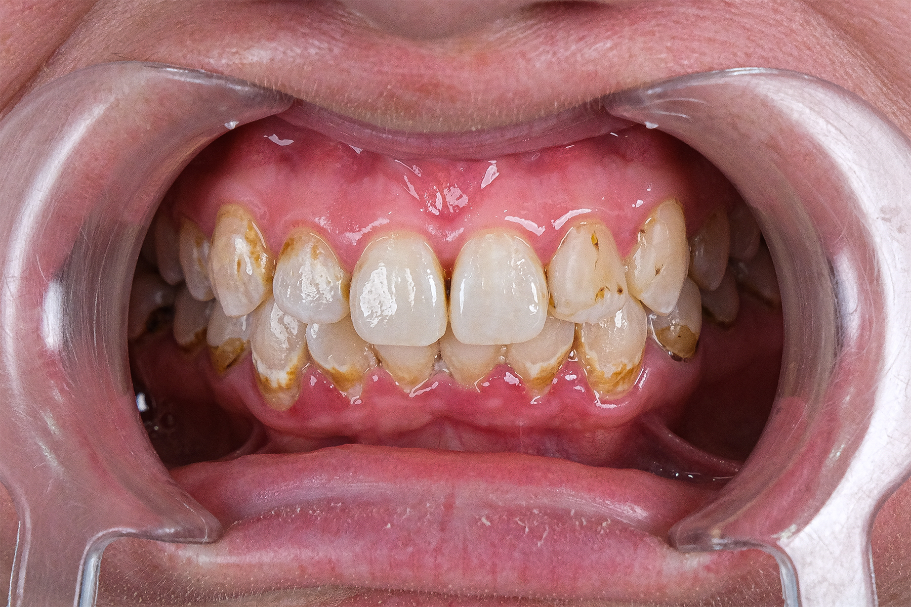 Zirconium crown smile transformation before and after at Luxury Dental - before treatment