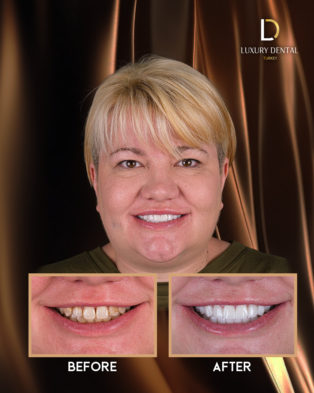 Zirconium crown smile transformation before and after at Luxury Dental