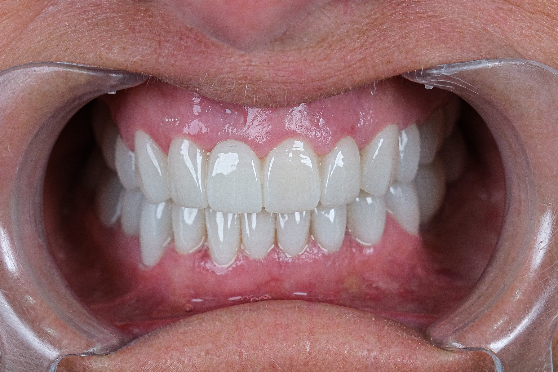 Zirconium crown smile transformation before and after at Luxury Dental - after treatment