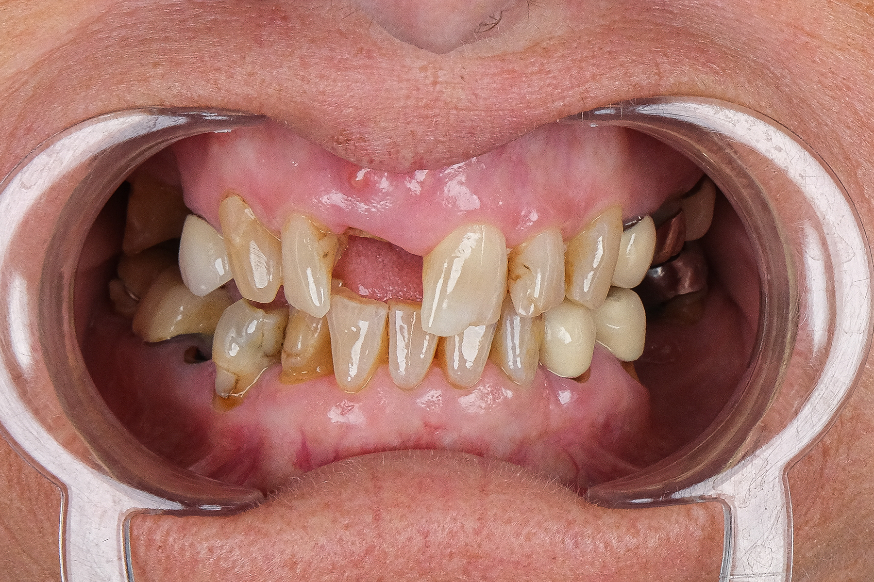 Zirconium crown smile transformation before and after at Luxury Dental - before treatment