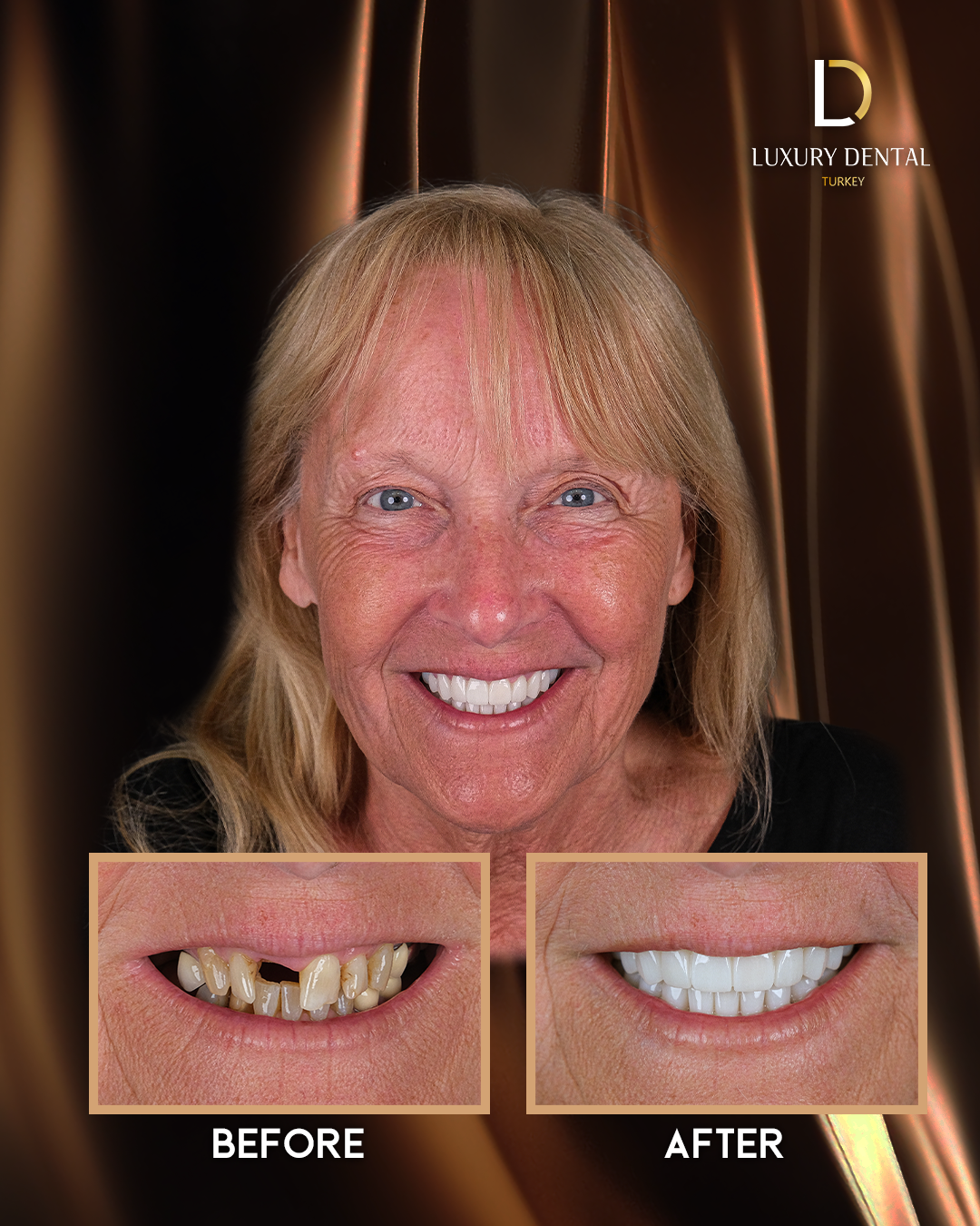 Zirconium crown smile transformation before and after at Luxury Dental
