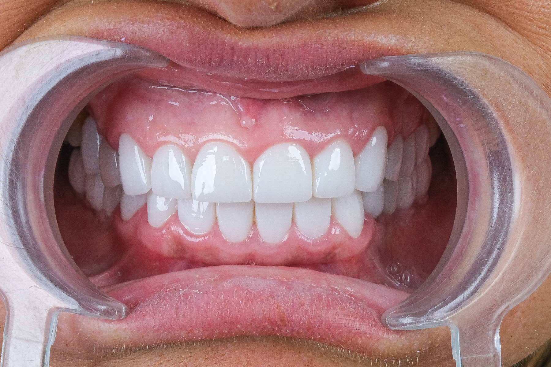 Zirconium crown smile transformation before and after at Luxury Dental - after treatment