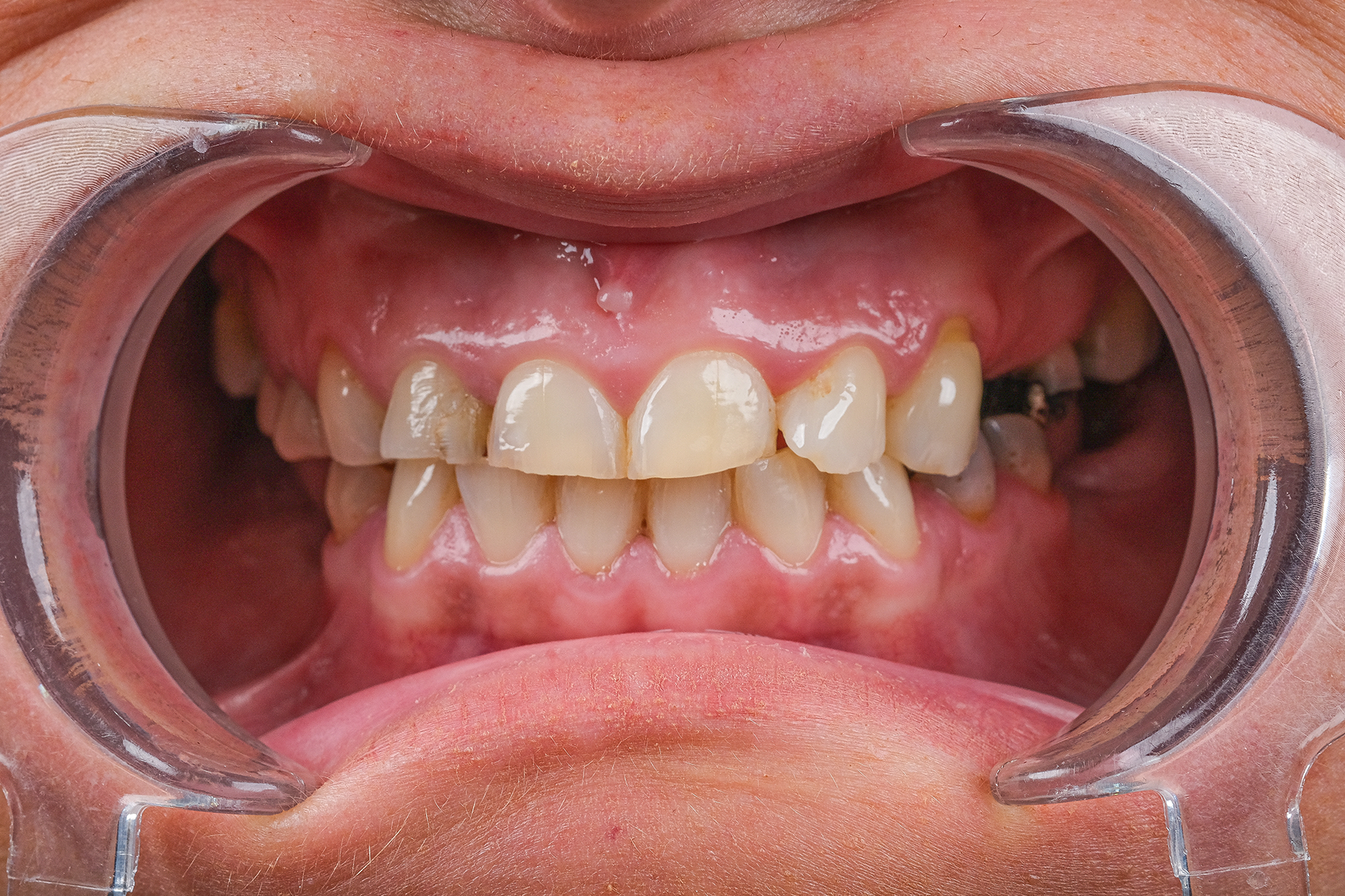 Zirconium crown smile transformation before and after at Luxury Dental - before treatment