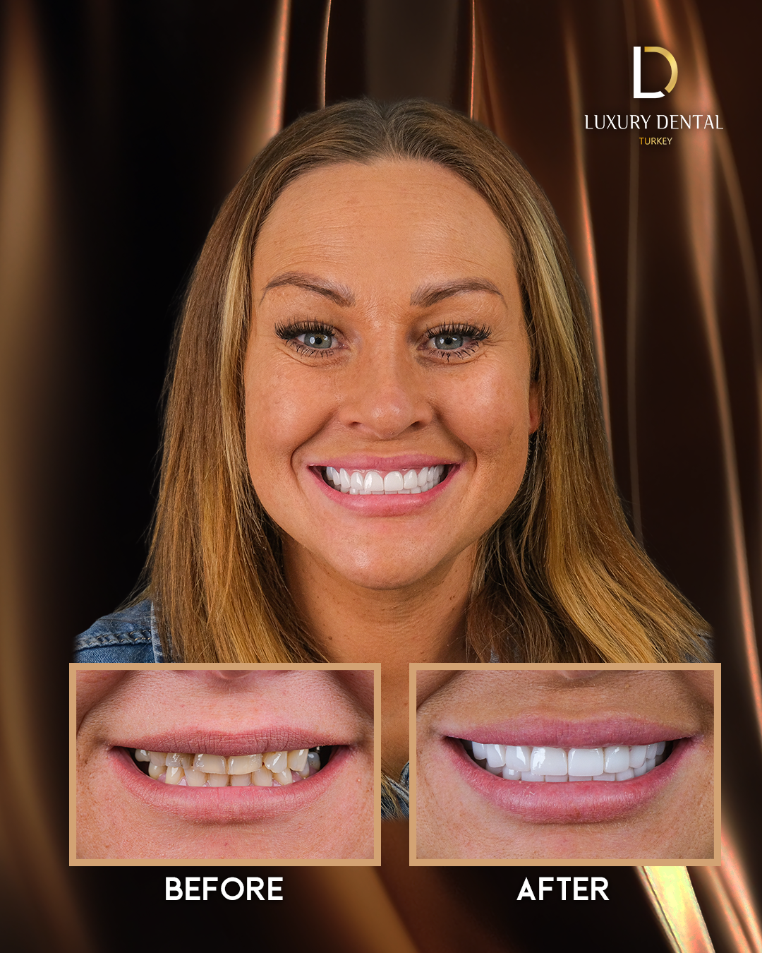 Zirconium crown smile transformation before and after at Luxury Dental