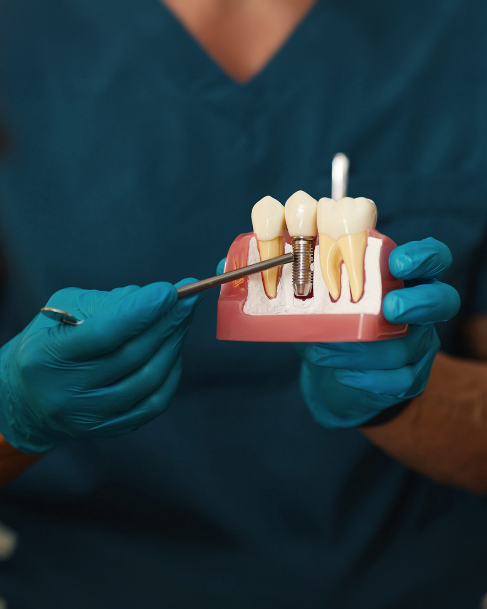 Premium titanium dental implant procedure at Luxury Dental clinic in Antalya, Turkey - 3D-guided implant placement by experienced oral surgeon