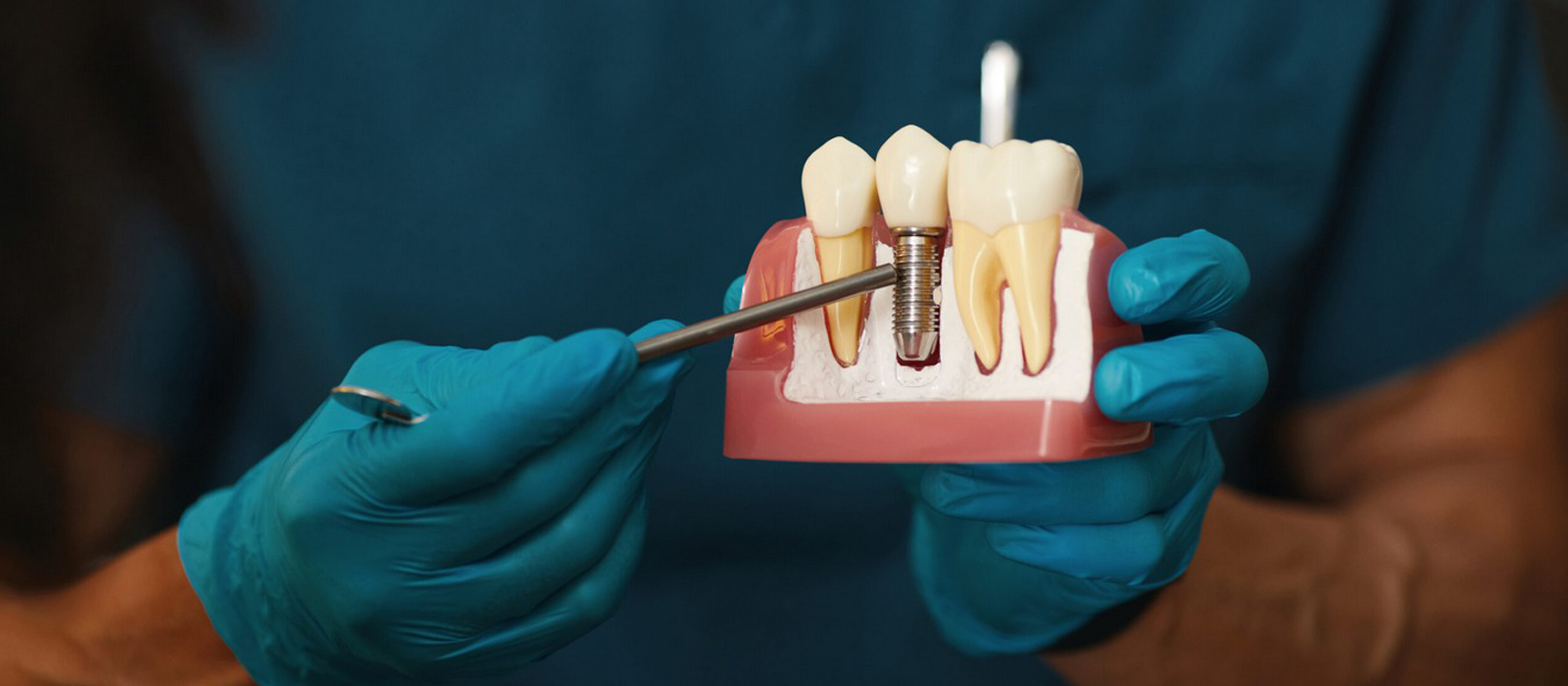 Premium titanium dental implant procedure at Luxury Dental clinic in Antalya, Turkey - 3D-guided implant placement by experienced oral surgeon