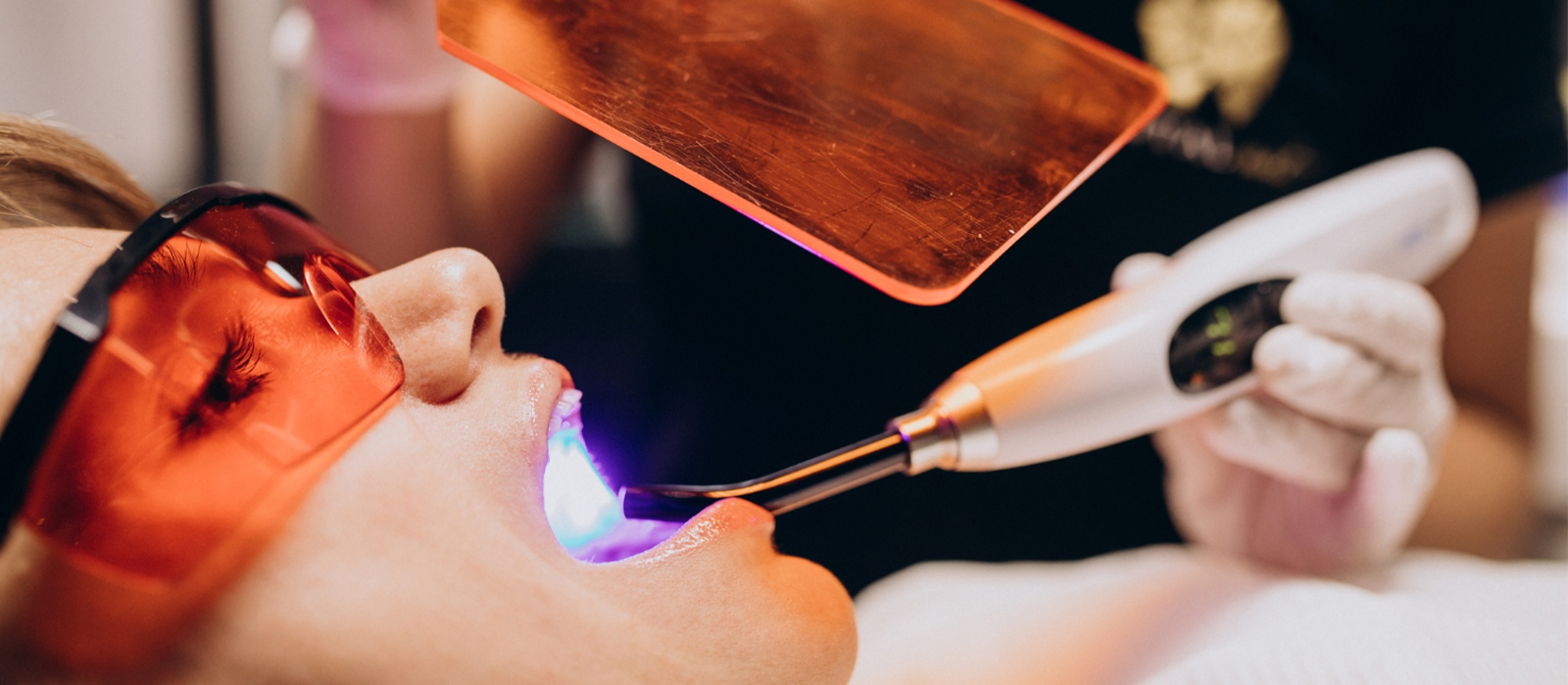 Professional laser teeth whitening treatment at Luxury Dental clinic in Antalya, Turkey - LED-activated whitening procedure